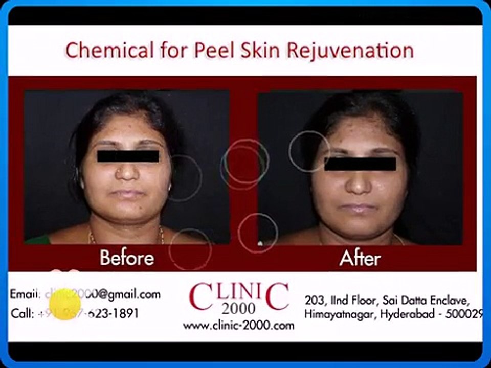 Chemical for Peel Skin Rejuvenation - Laser Skin Resurfacing [360p]