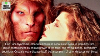 Lion Face Syndrome