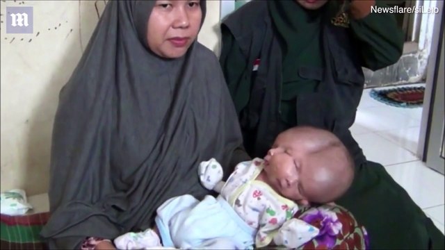 Ce bébé est né avec deux visages et deux cerveaux mais un seul corps et un seul crane