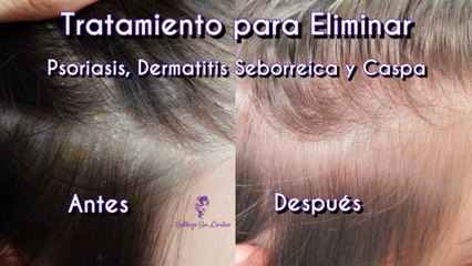 Tratamiento para Eliminar Psoriasis, Dermatitis Seborreica y Caspa