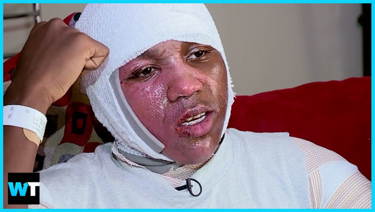 ANOTHER TEEN Severely Burned During HOT WATER CHALLENGE!!