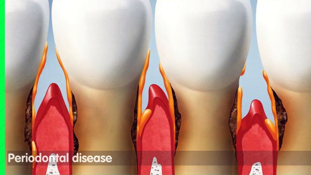 Periodontal Treatments and Procedures