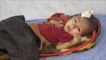 سوء التغذية كابوس يلاحق أطفال اليمن