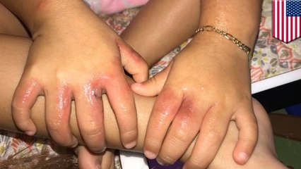 3歳女児がビーチで細菌感染 米 - トモニュース