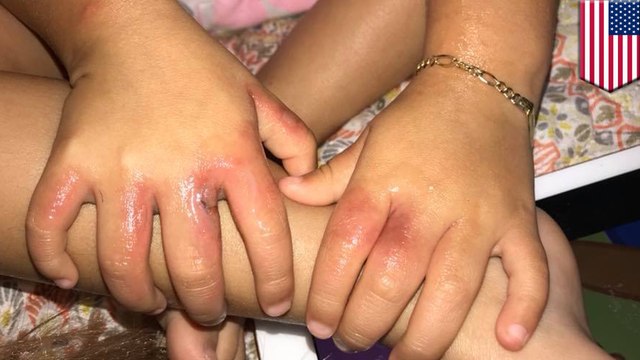 3歳女児がビーチで細菌感染 米 - トモニュース