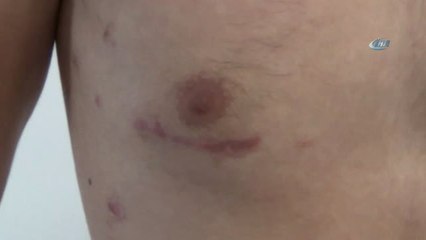Göğüs Kafesi Açılmadan Delik Kalbi Ameliyat Edildi