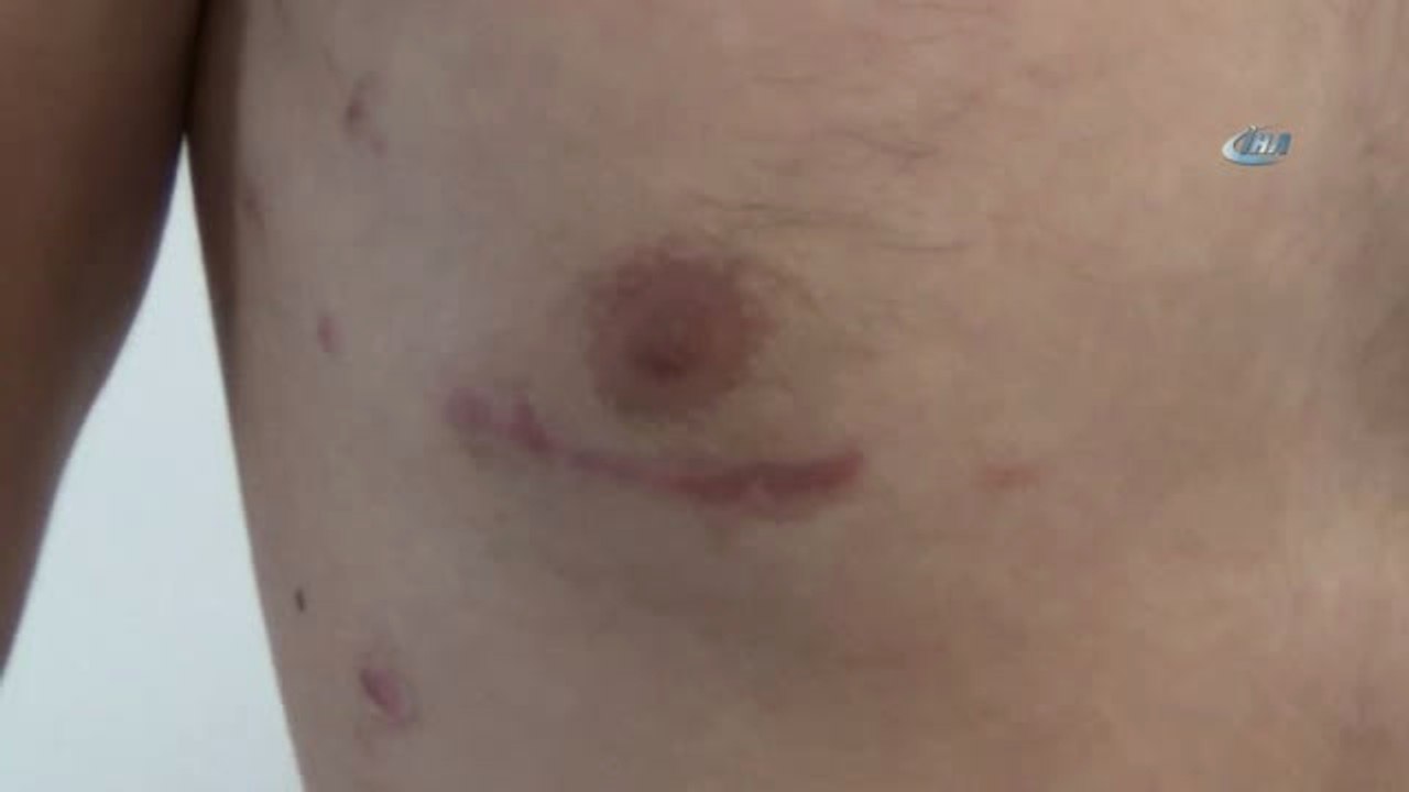 Göğüs Kafesi Açılmadan Delik Kalbi Ameliyat Edildi