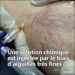 Voici le traitement (sclérothérapie) pour en finir avec les veines varices ou les "araignées" vasculaires.