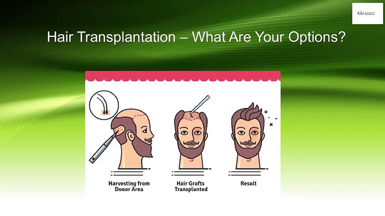 Hair_Transplantation_What_Are_Your_Options