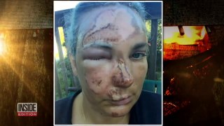 How Woman Recovered From Facial Burns After Falling on Hot Grill