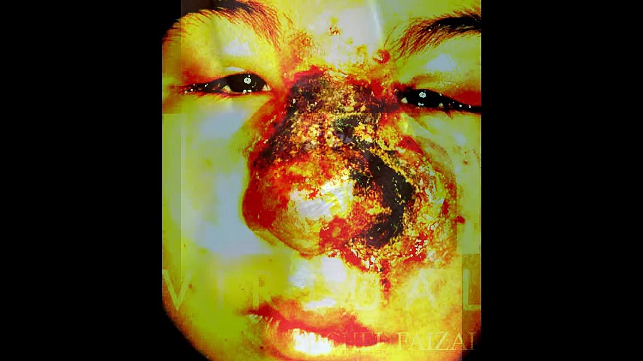 LEISHMANIASIS o enfermedad zombie