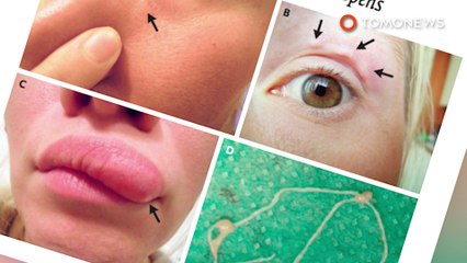 얼굴 위에서 움직이는 혹, 알고보니...