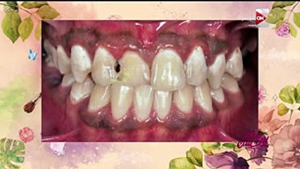 مدرس بـ"طب الأسنان": التقويم يحرك السِنة 1 مل كل شهر