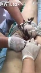 Ce médecin enlève du pus de la fesse d'un patient... horrible