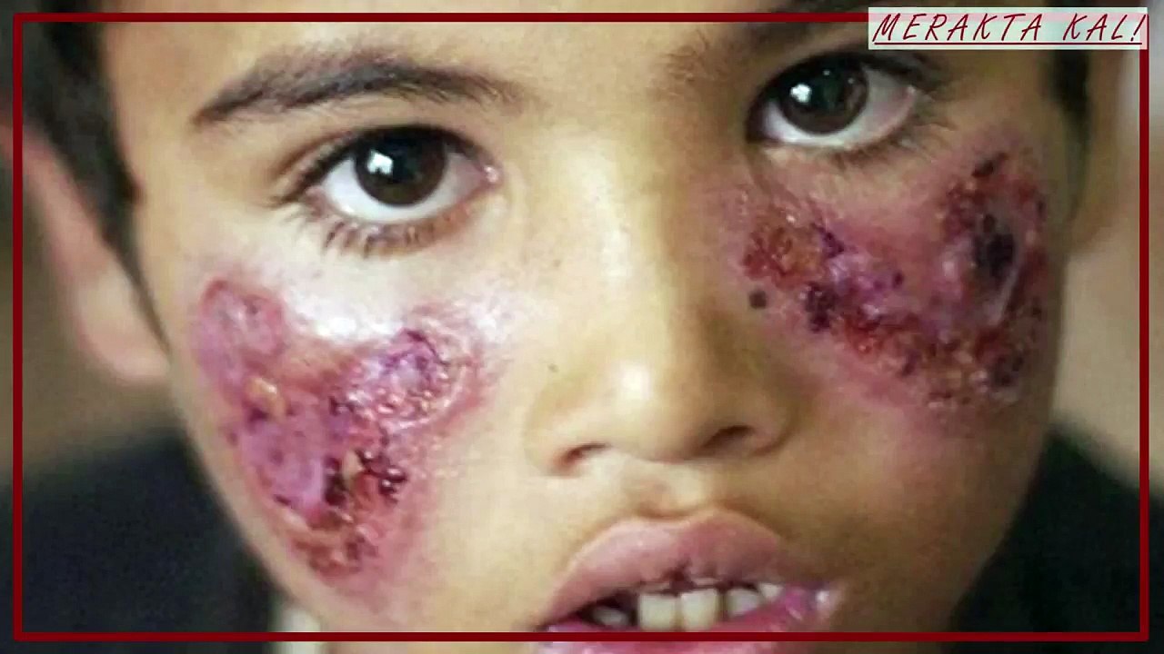 Japonyada Et Yiyen Bakteri Paniği! Yüzlerce Kişiye Enfeksiyon Bulaştı