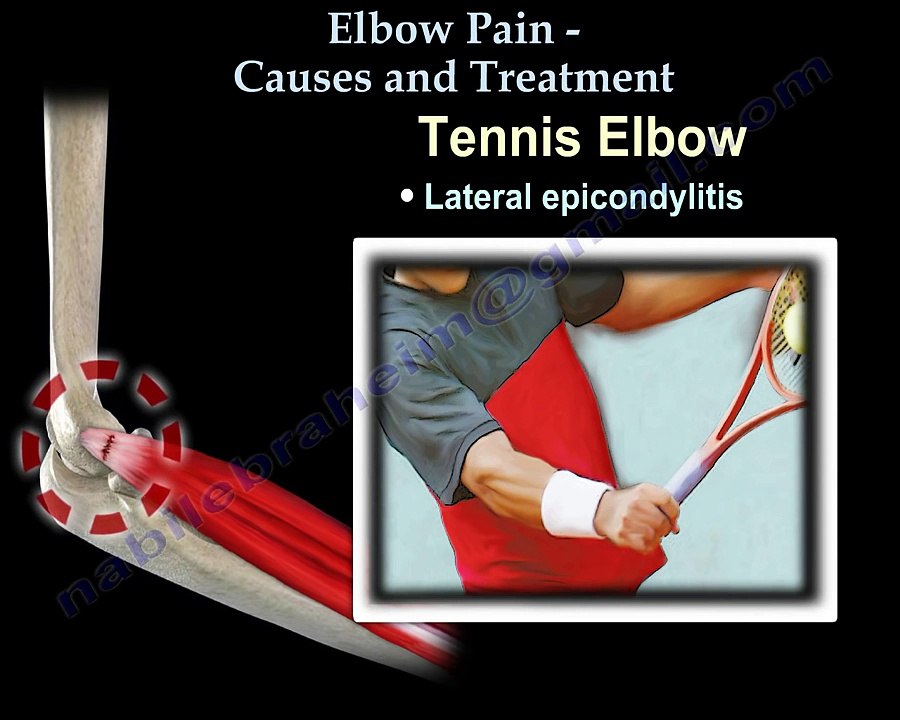 ELBOW PAIN CAUSES AND TREATMENT - Everything You Need To Know - Dr. Nabil Ebraheim