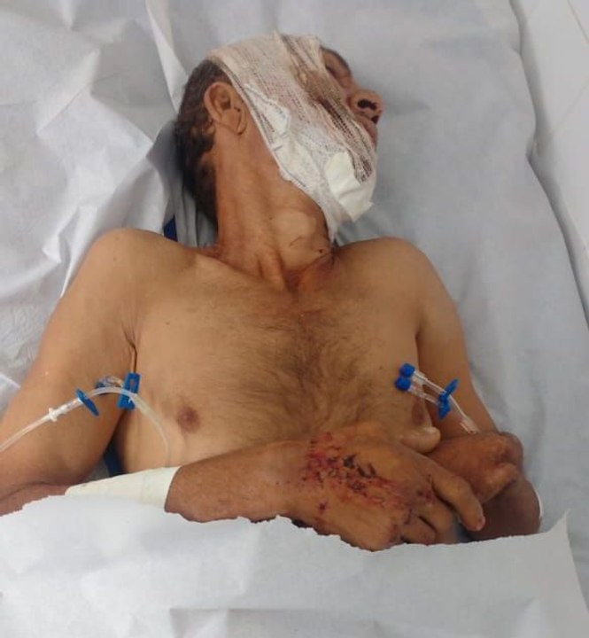 Atropelado, fraturado e sem regulação