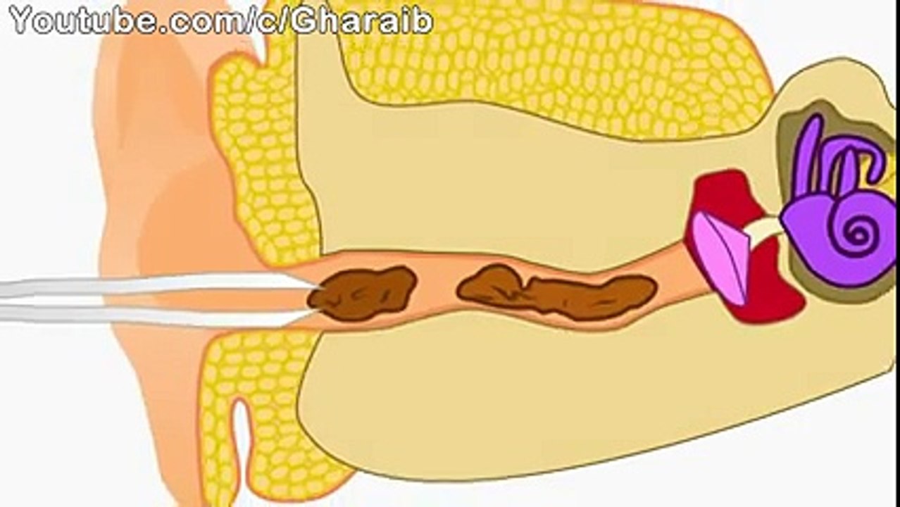 طريقة رائعة لستخراج الشمع والاوساخ من الأذن دون مخاطرة