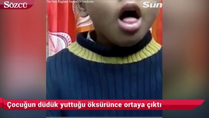 Çocuğun düdük yuttuğu öksürünce ortaya çıktı