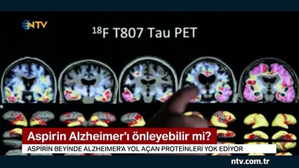 Aspirin Alzheimer'ı önleyebilir mi?