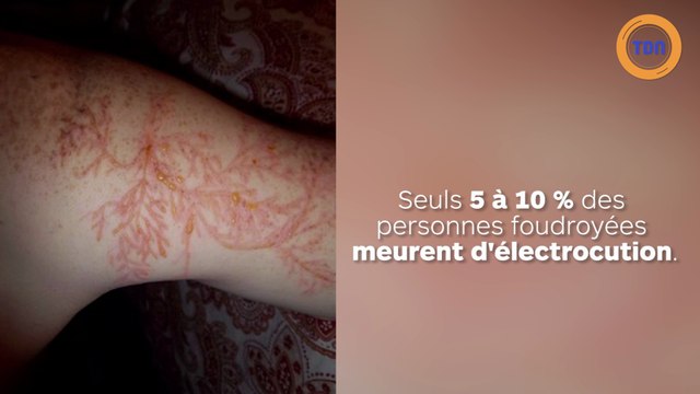 Les survivants frappés par la foudre dévoilent les intrigantes cicatrices causées par les éclairs !