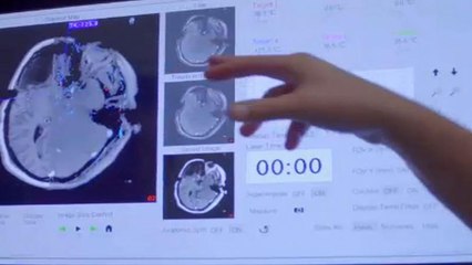 Θεραπεία της επιληψίας με laser και στην Ευρώπη