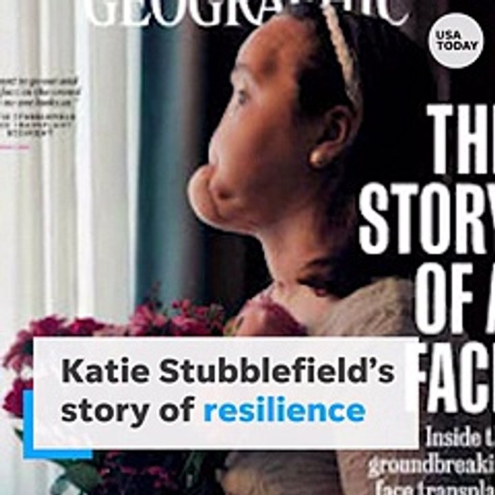 Face transplant recipient tells her story with National Geographic