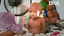 Au Tchad, un hôpital construit en urgence pour faire face à la malnutrition aiguë sévère