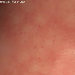 Elastic Glue Seals Wounds In 60 Seconds