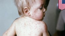 US actually has measles outbreaks in 21 states