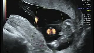 16 weeks Ultrasound Its a Boy!!!