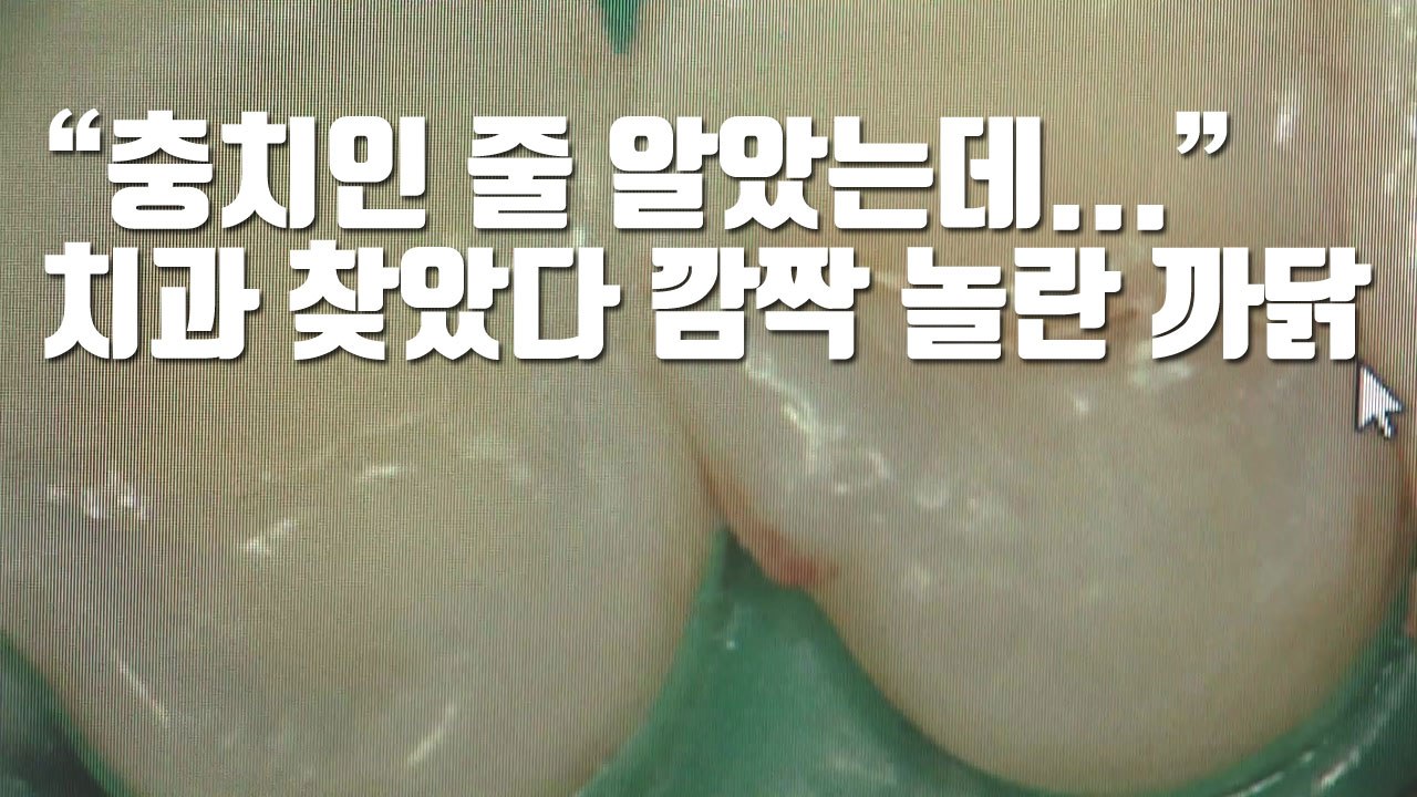 [자막뉴스] "충치인 줄 알았는데..." 치과 찾았다 깜짝 놀란 까닭 / YTN