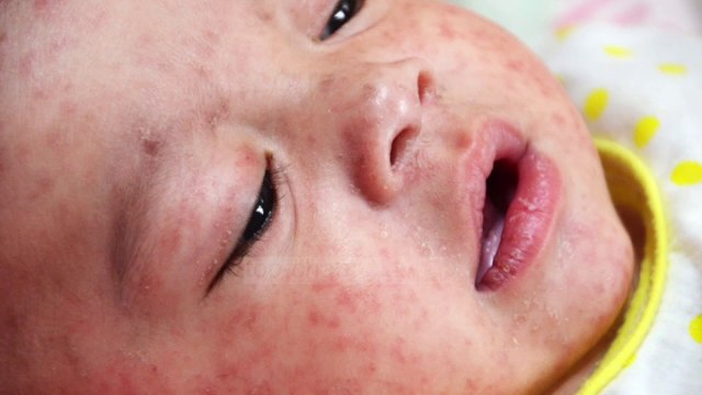 OBSH: Mbi 41 mijë të infektuar dhe 37 të vdekur nga fruthi - Top Channel Albania - News - Lajme