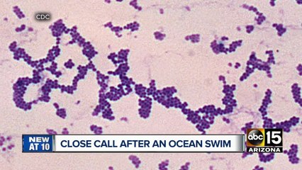 Phoenix man survives beach infection while in San Diego