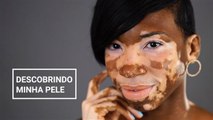 Como esta modelo com vitiligo aprendeu a ter confiança em si mesma