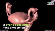 Toma nota de los síntomas del ovario poliquístico