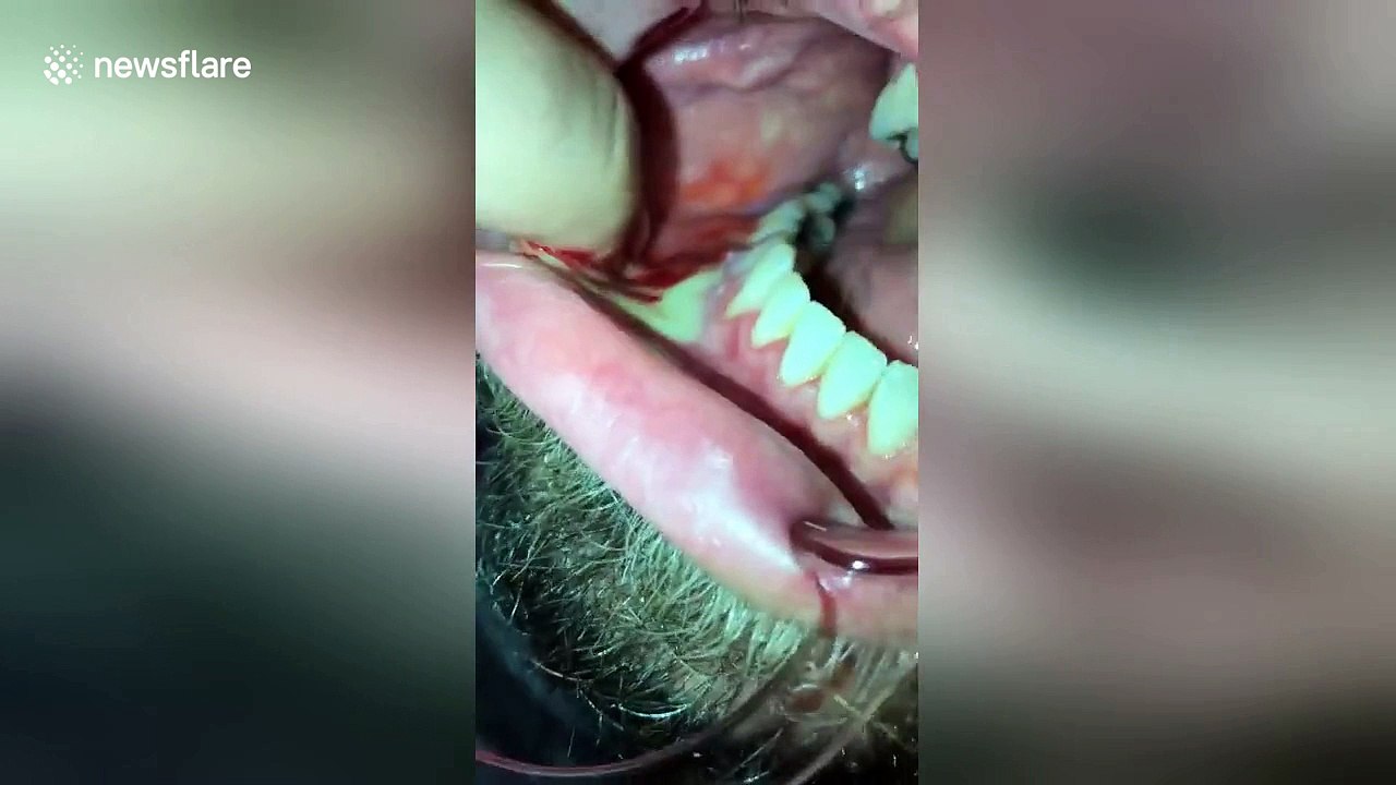 Abscess floods man's mouth with yellow pus video Dailymotion