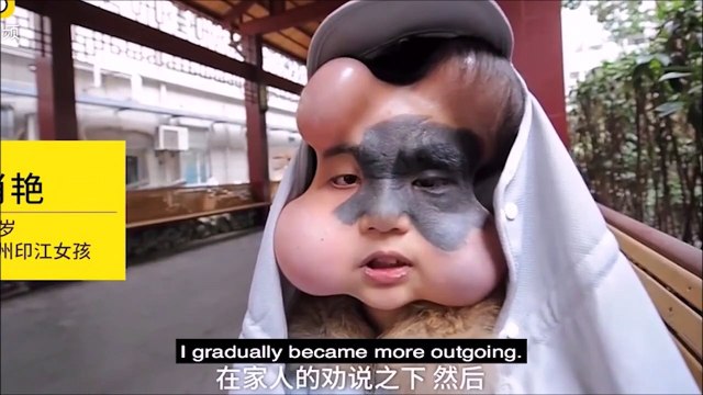 Il se fait implanter 4 ballons pour une raison incroyable