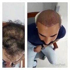 Saç dökülmesine medikal tedavi