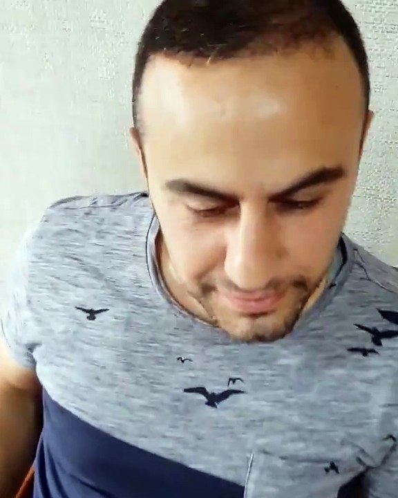 Saç ekiminde 5. ay