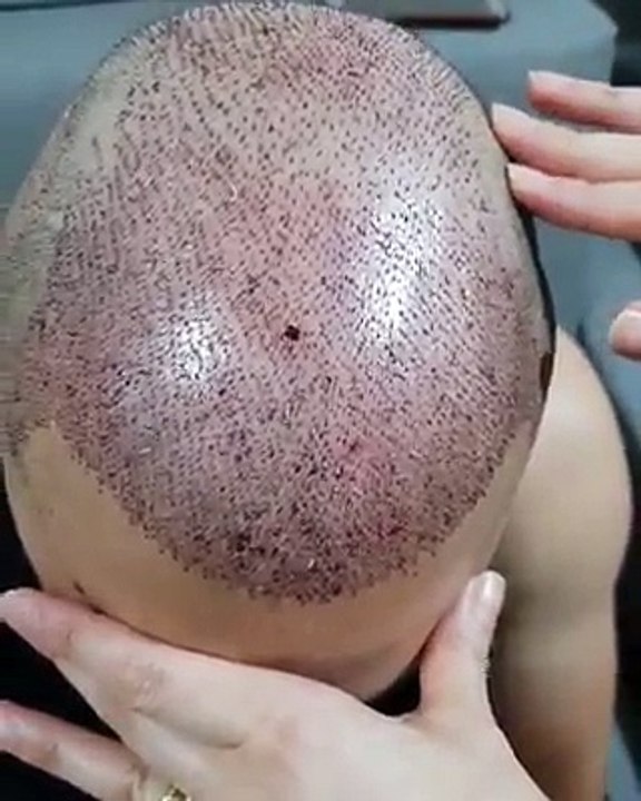 Hair Transplant Clinic