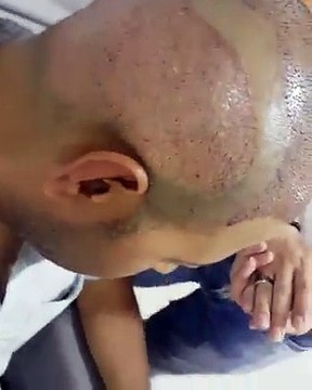 Zeytinburnu saç ekimi merkezi