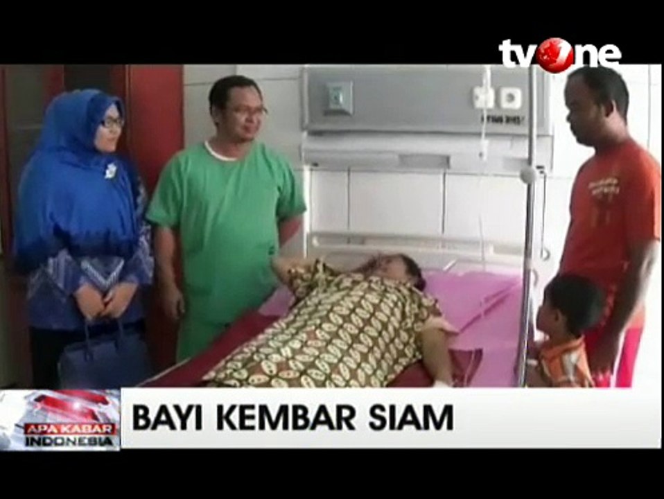 Bayi Kembar Siam Dempet Kepala Lahir di RS H. Sahudin Aceh