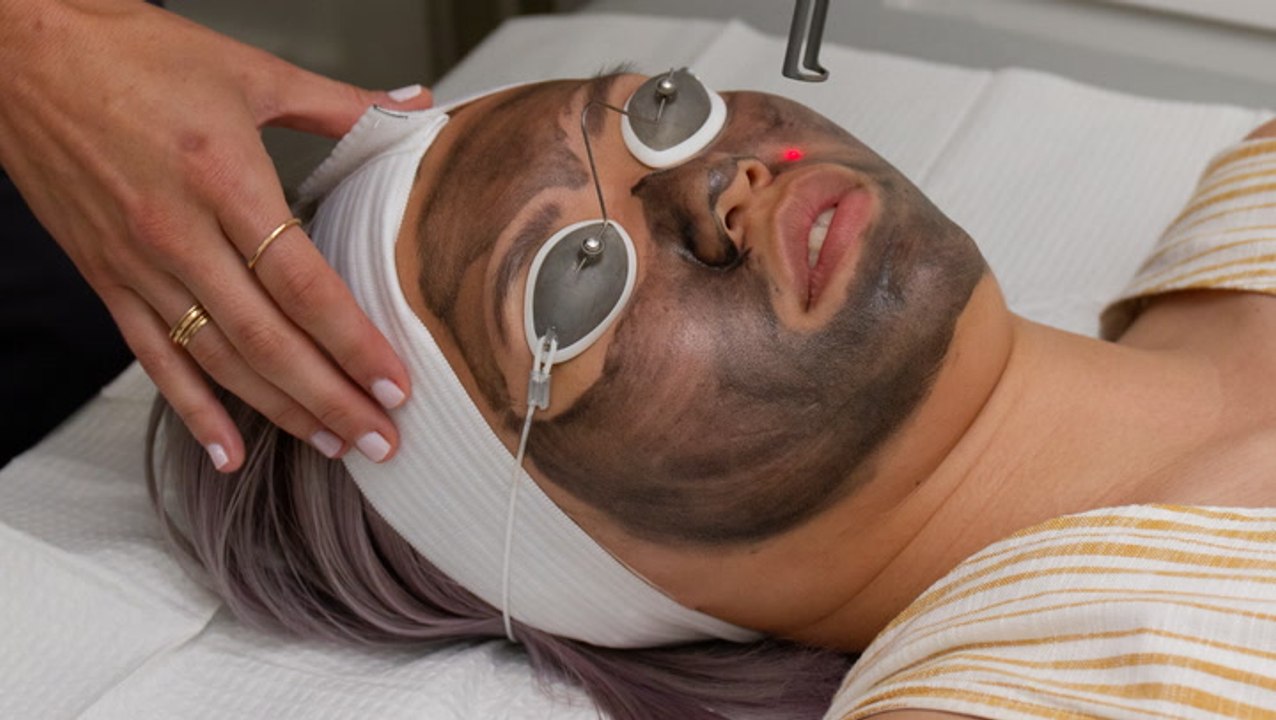I Got A Laser Facial With A Charcoal Bonus