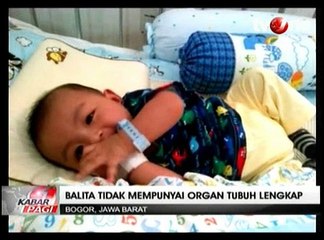 Balita 1,5 Tahun Hidup Tanpa Organ Tubuh Lengkap