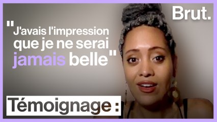 Sarah Fremgen souffre de cicatrices chéloïdes