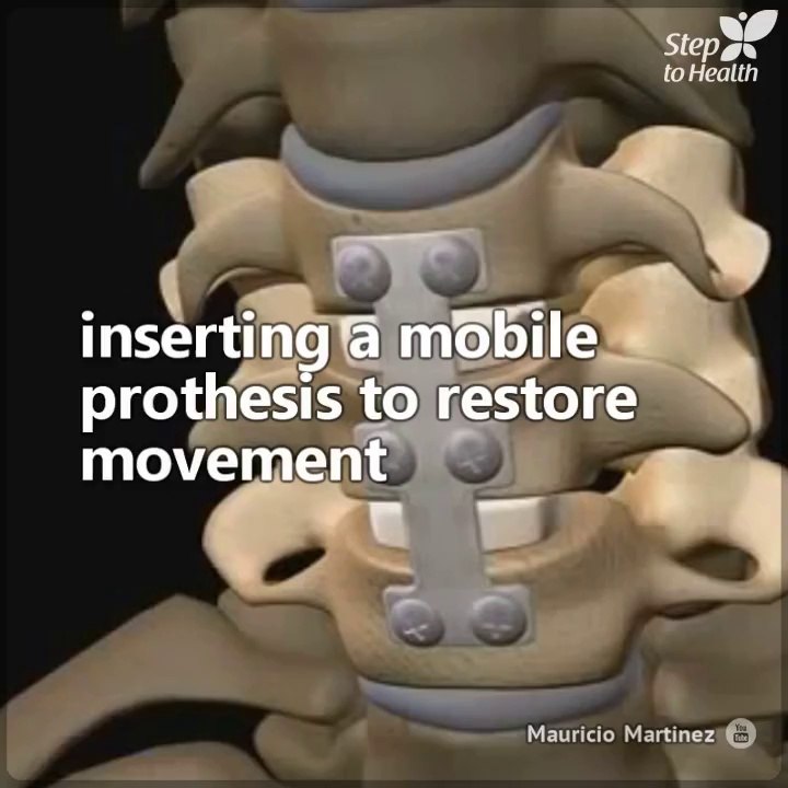 This is what an artificial disc replacement surgery consists of