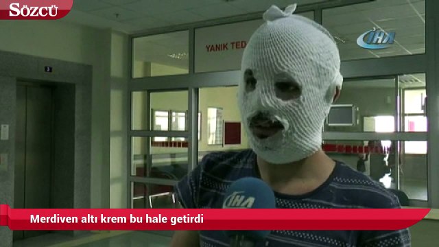 Merdiven altı krem yüzünü yaktı