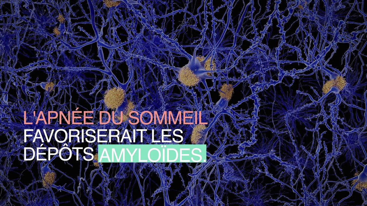 Maladie d'Alzheimer : un lien avec l’apnée du sommeil ?