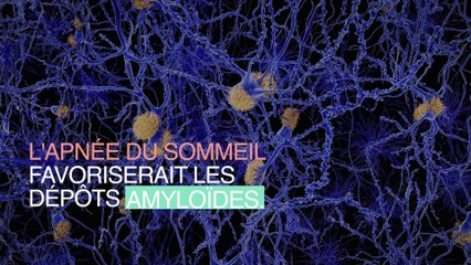 Maladie d'Alzheimer : un lien avec l’apnée du sommeil ?